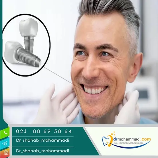 عملکرد جویدن، صحبت کردن و زیبایی بعد از ایمپلنت